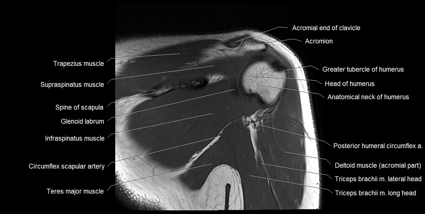 mri shoulder coronal cross sectional anatomy image 14.webp